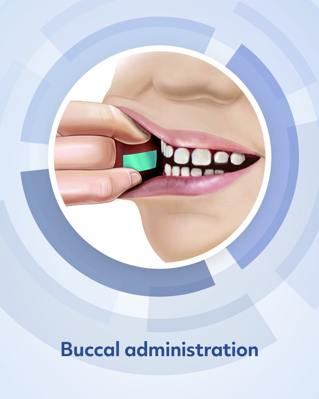 Image labeled "buccal administration", showing a pharmfilm strip being applied to the inside of the cheek.