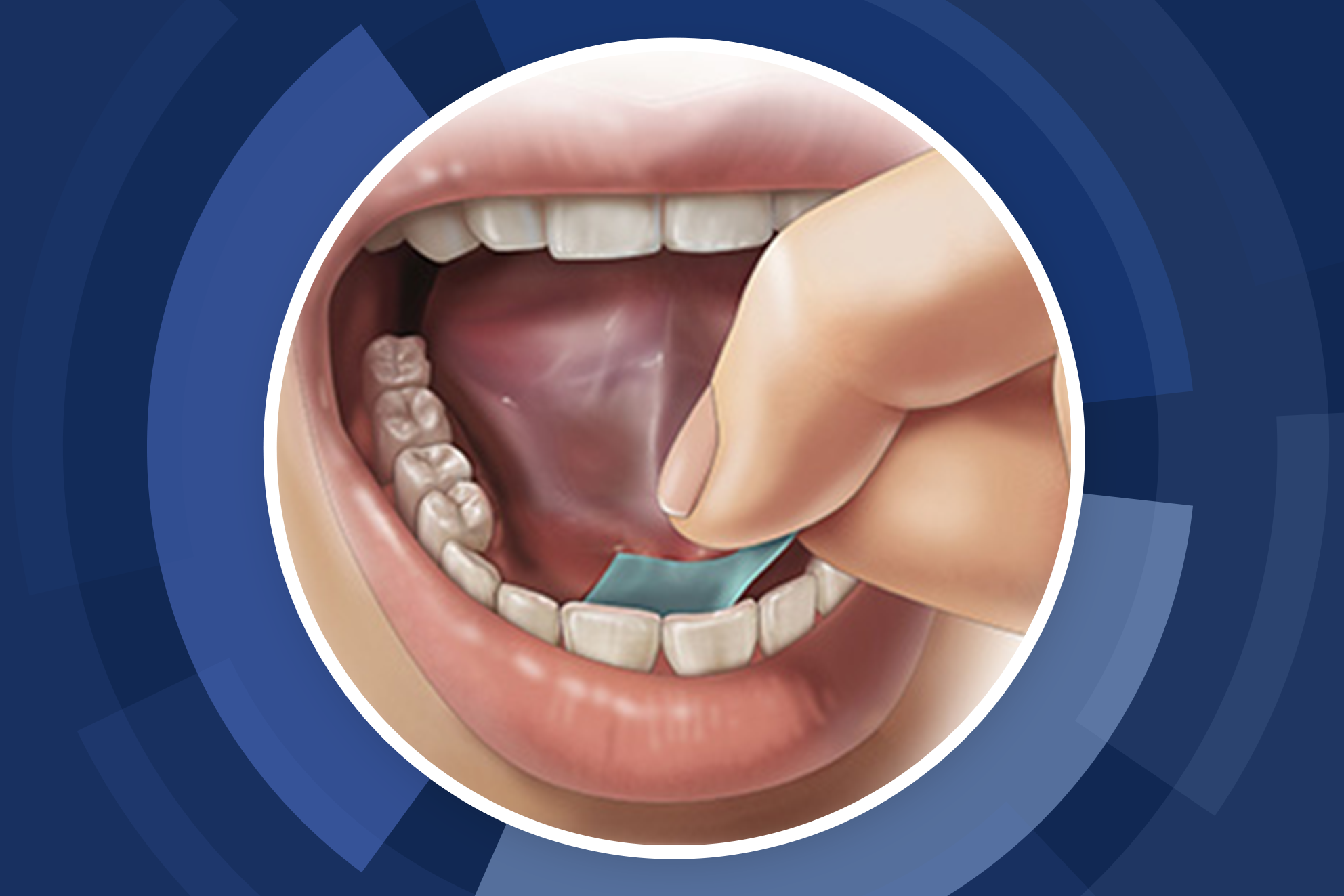 Thumbnail image showing the sublingual administration of a pharmfilm oral medical strip.
